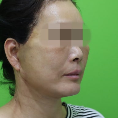 안면거상술, 이중턱 근육 묶기 후 회복 기간 관련 이미지 28