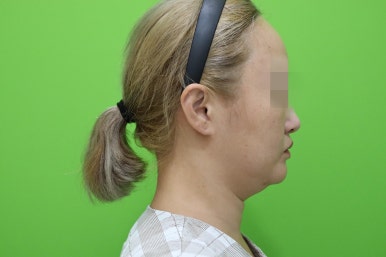이중턱살제거, 마른 몸에 이중턱만 고민이라면? 관련 이미지 15