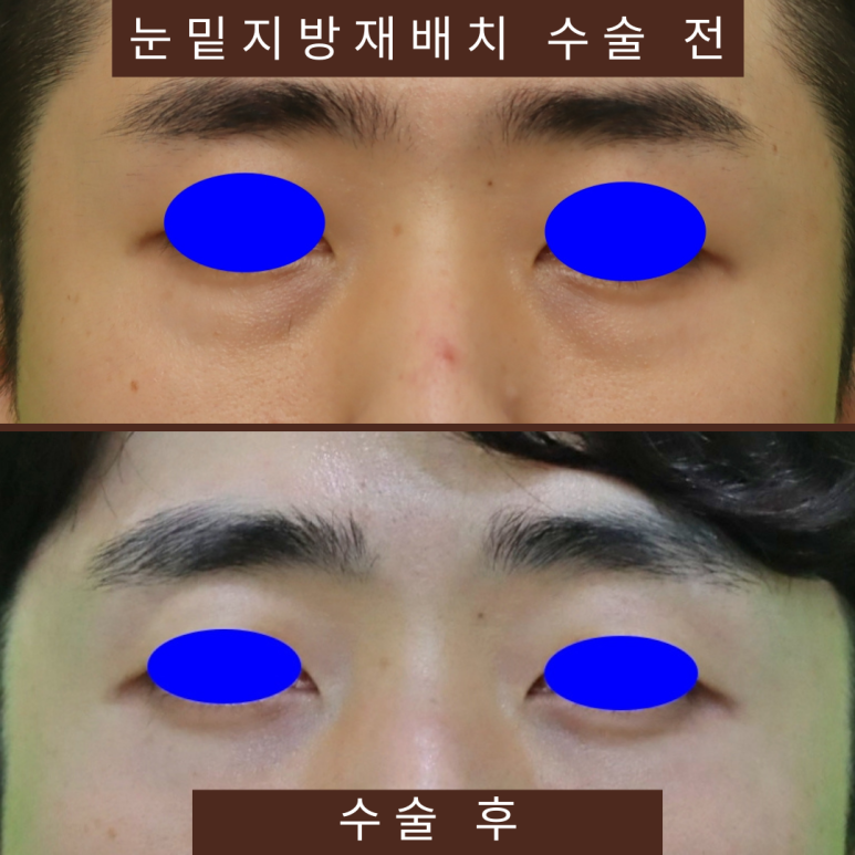 3 Things You Must Know Before Male Under-Eye Fat Repositioning image 9