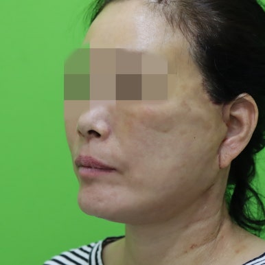 안면거상술, 이중턱 근육 묶기 후 회복 기간 관련 이미지 22