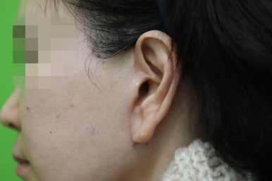 안면거상 재수술, 왜 3년전 수술이 효과가 없었을까? 관련 이미지 27