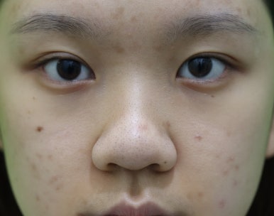 복코성형, 연예인 지망생의 리얼 후기 관련 이미지 16