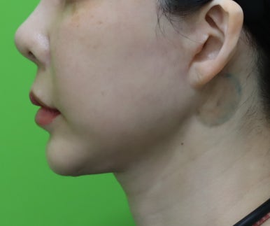 Facelift Results: Can They Be Good Even at a Young Age? image 12