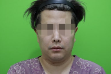 Double Chin Muscle Tying Swelling, Day 1 Appearance image 1