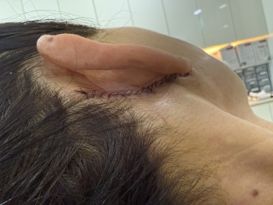 안면거상 후 켈로이드 흉터 치료 후기 관련 이미지 5