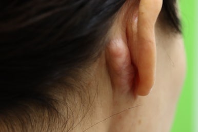 안면거상 후 켈로이드 흉터 치료 후기 관련 이미지 1