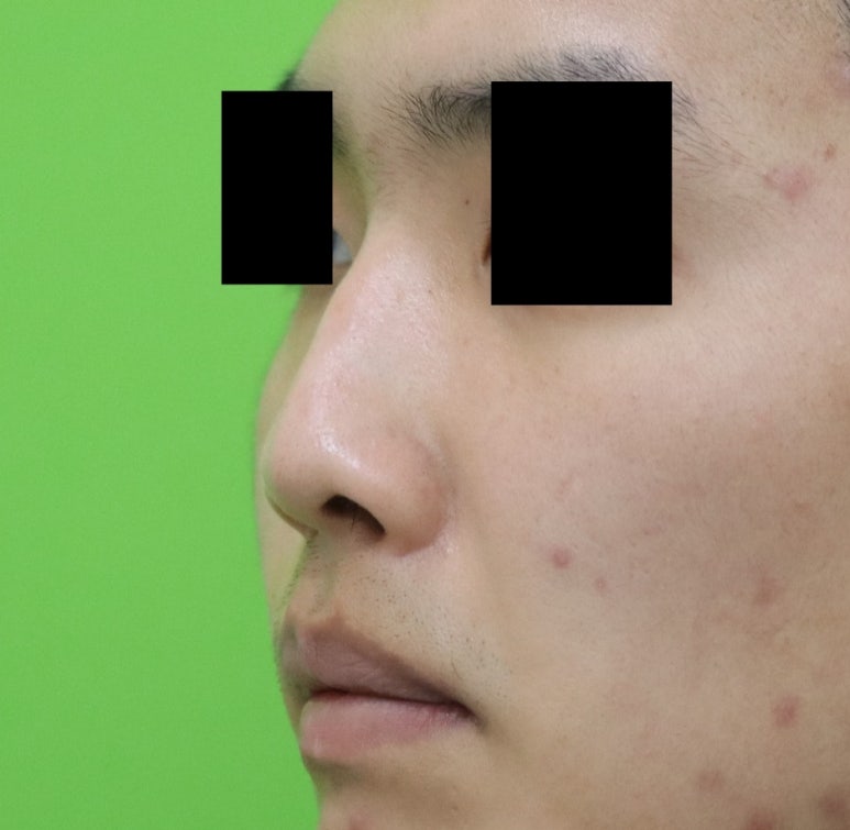 Crooked Nose Surgery: If You Don’t Know This, You’ll Need Revision Surgery Again. image 4