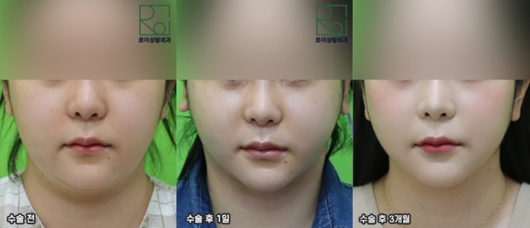 Double Chin Removal: Did You Think Liposuction Alone Would Be Enough? image 3