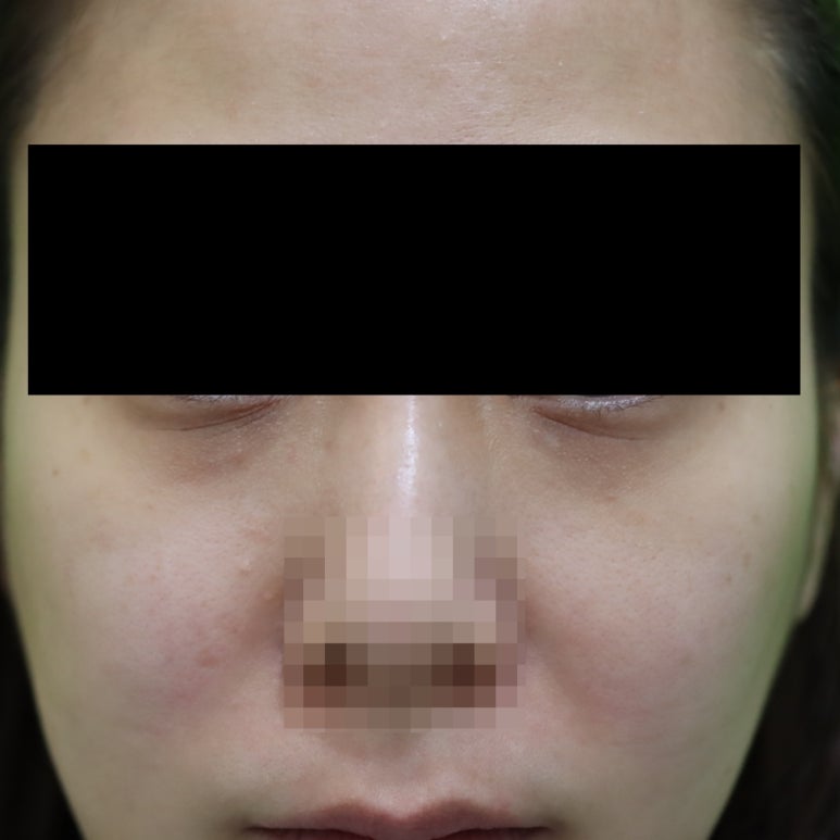 웃을때 눈밑지방, 정말 근육이라 개선이 안될까? 관련 이미지 1