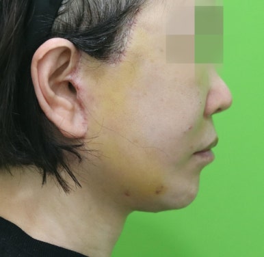 안면거상 재수술, 왜 3년전 수술이 효과가 없었을까? 관련 이미지 10