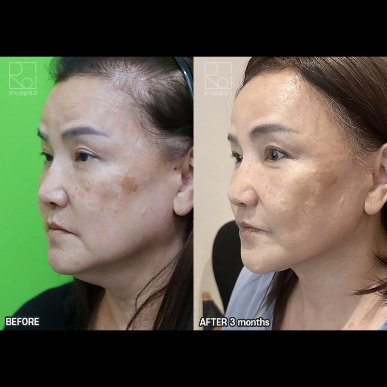 Facelift Review: A Woman in Her Early 60s Looks More Than 10 Years Younger image 7