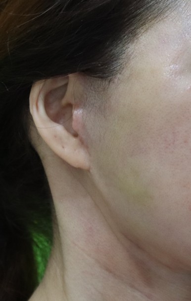 Facelift Scars, the Reason They Look Seamless After 6 Months image 11