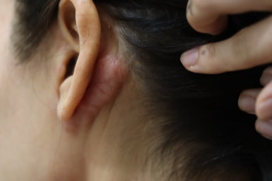 안면거상 후 켈로이드 흉터 치료 후기 관련 이미지 2