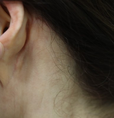 Facelift Scars, the Reason They Look Seamless After 6 Months image 24