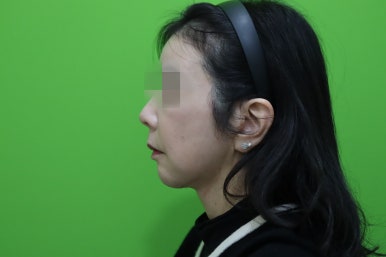 50대 여성 안면거상술 및 이중턱 근육묶기 후기 관련 이미지 12