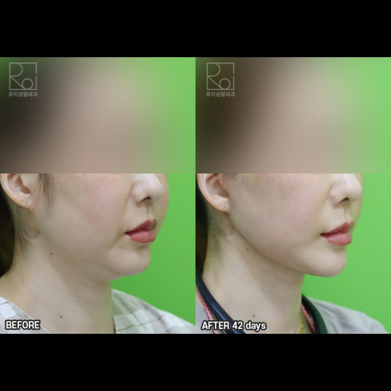 Facelift Results: Can They Be Good Even at a Young Age? image 5