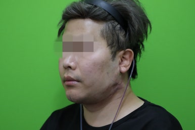Double Chin Muscle Tying Swelling, Day 1 Appearance image 8