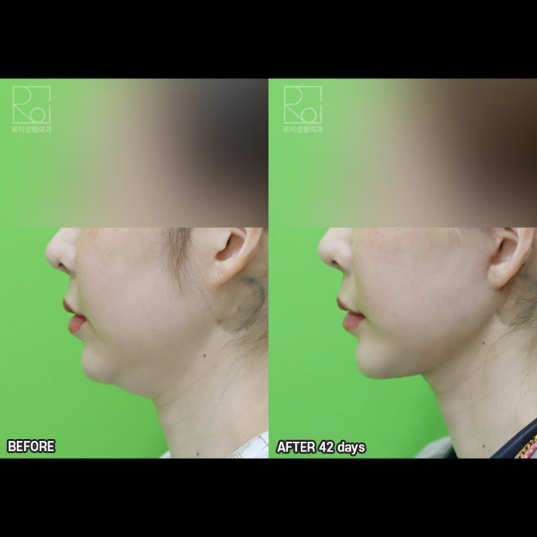 Facelift Results: Can They Be Good Even at a Young Age? image 7