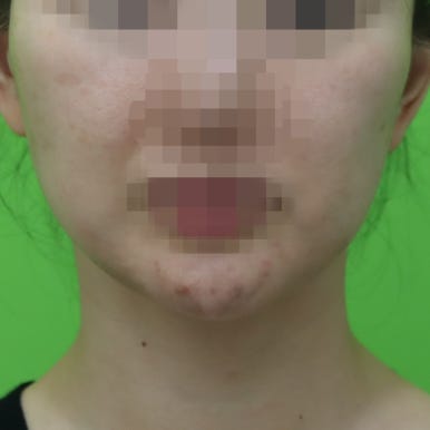 몸은 말랐는데 이중턱살제거가 시급할 때? 관련 이미지 12