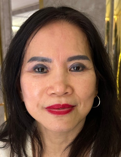 Revision Facelift 3 Months Later, Including Removal of the Existing Scar image 5