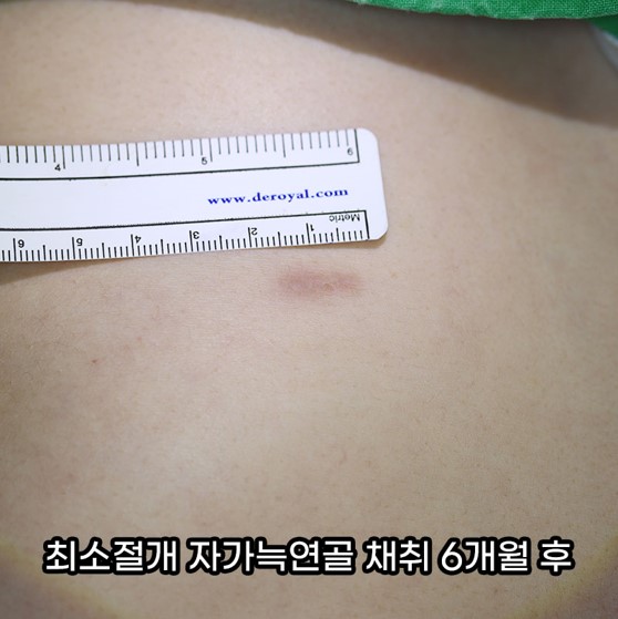 복코성형, 연예인 지망생의 리얼 후기 관련 이미지 5