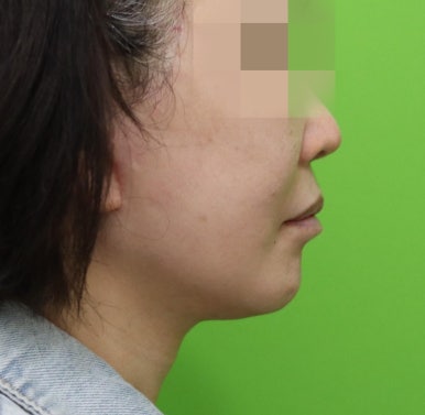 안면거상 재수술, 왜 3년전 수술이 효과가 없었을까? 관련 이미지 14