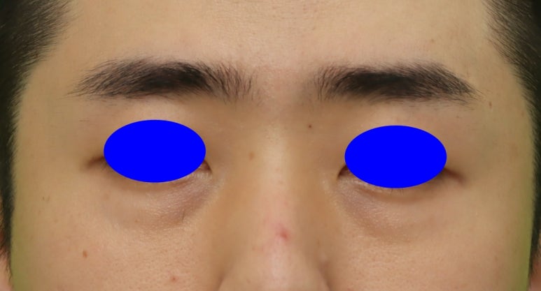 3 Things You Must Know Before Male Under-Eye Fat Repositioning image 1