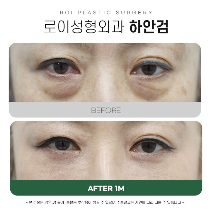 Under-Eye Fat Repositioning vs. Lower Blepharoplasty: Selection Criteria You Should Know image 2