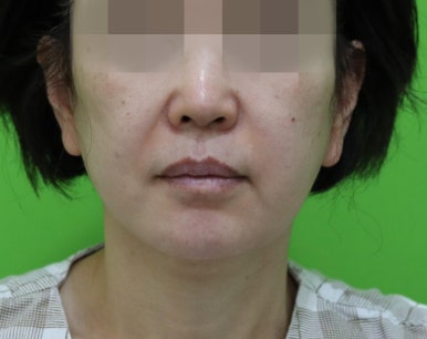 안면거상 재수술, 왜 3년전 수술이 효과가 없었을까? 관련 이미지 3