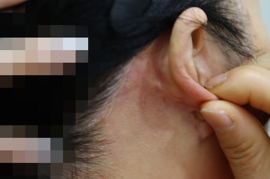 안면거상 흉터, 이중턱 근육묶기 흉터 1년 뒤 모습은? 관련 이미지 7