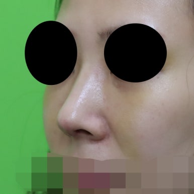 매부리코교정, 코뼈 제거 없이 재배치로 해결 관련 이미지 5