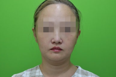이중턱살제거, 마른 몸에 이중턱만 고민이라면? 관련 이미지 5