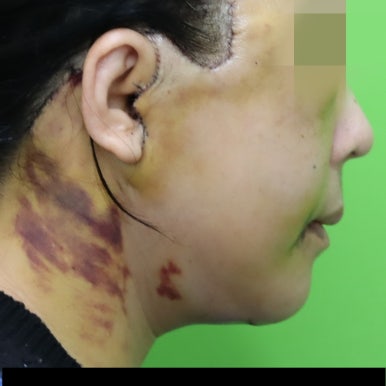 Early Swelling Changes After Facelift (Day 3, 1 Week, 2 Weeks) image 15