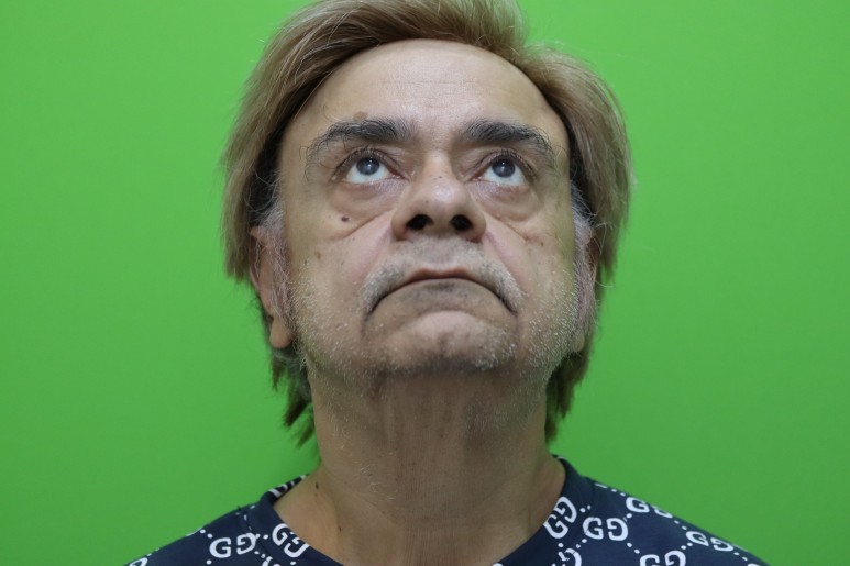 Facelift Review: Why the Neck Lift Technique Matters image 3