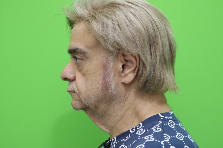Facelift Review: Why the Neck Lift Technique Matters image 5