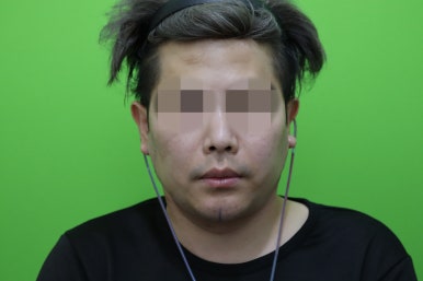 Double Chin Muscle Tying Swelling, Day 1 Appearance image 6