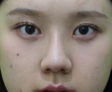 복코성형, 연예인 지망생의 리얼 후기 관련 이미지 17