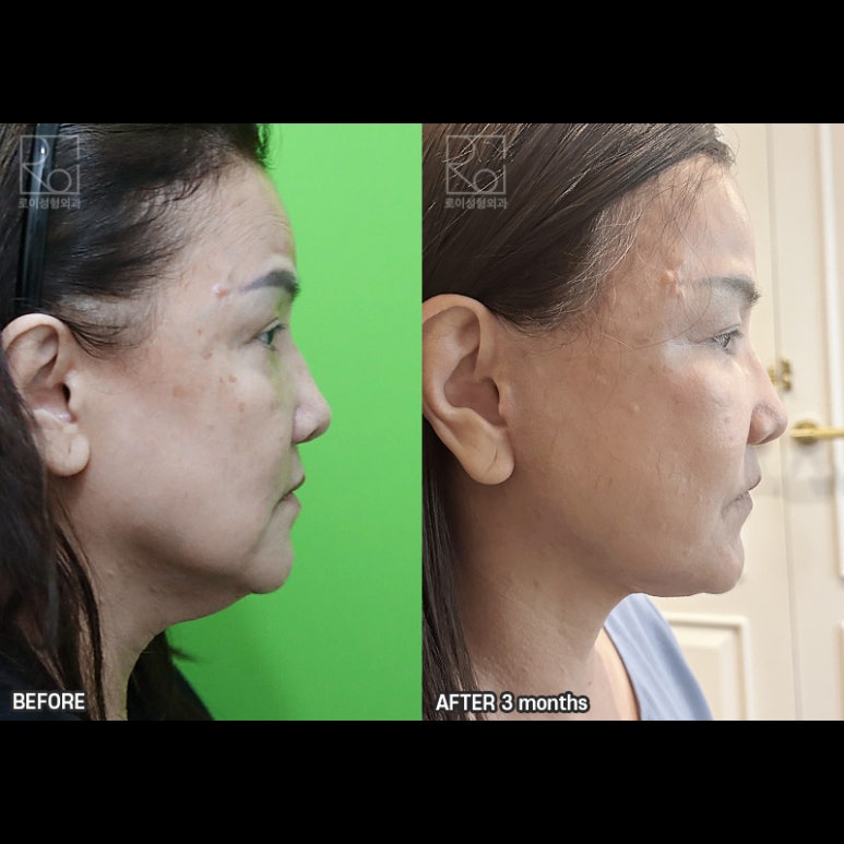 Facelift Review: A Woman in Her Early 60s Looks More Than 10 Years Younger image 10