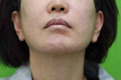 안면거상 재수술, 왜 3년전 수술이 효과가 없었을까? 관련 이미지 12