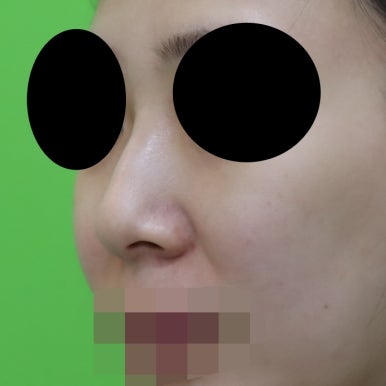 매부리코교정, 코뼈 제거 없이 재배치로 해결 관련 이미지 11