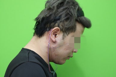 Double Chin Muscle Tying Swelling, Day 1 Appearance image 18