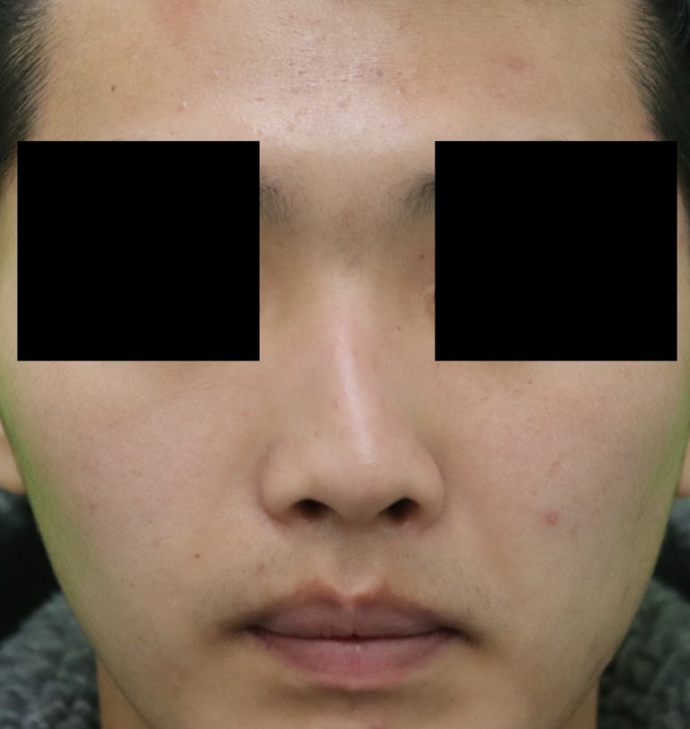 Crooked Nose Surgery: If You Don’t Know This, You’ll Need Revision Surgery Again. image 1