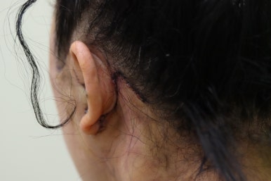 Early Swelling Changes After Facelift (Day 3, 1 Week, 2 Weeks) image 12