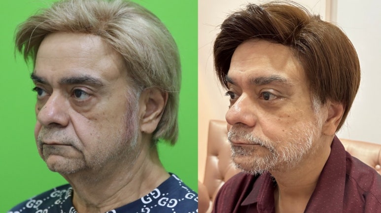 Facelift Review: Why the Neck Lift Technique Matters image 14