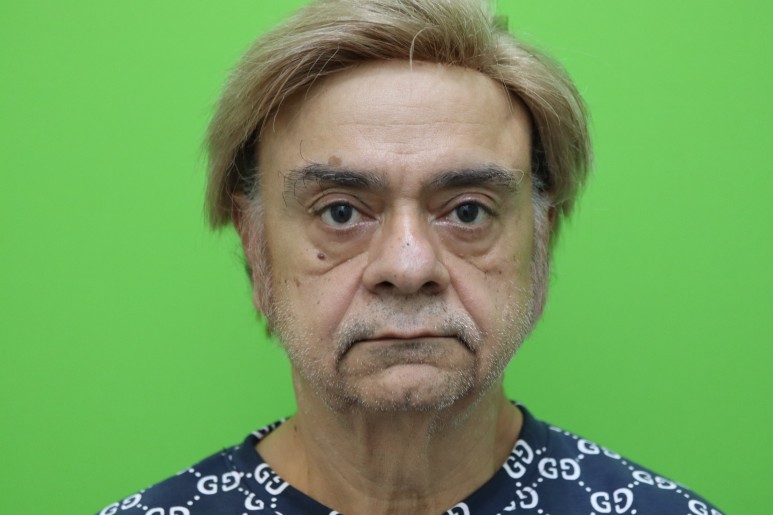 Facelift Review: Why the Neck Lift Technique Matters image 2
