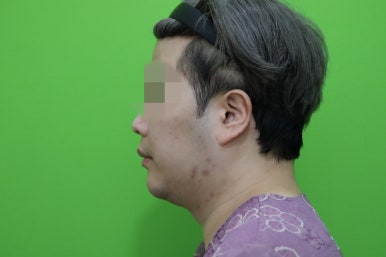 Double Chin Muscle Tying Swelling, Day 1 Appearance image 3
