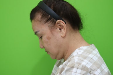 Facelift Review: A Woman in Her Early 60s Looks More Than 10 Years Younger image 3