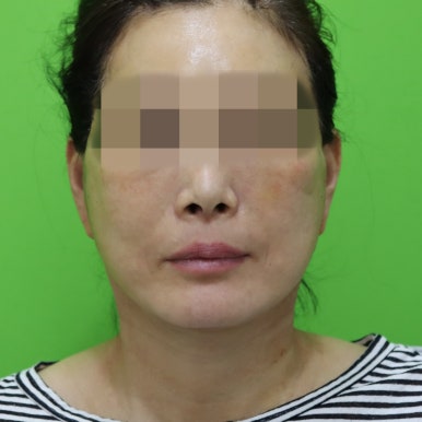 안면거상술, 이중턱 근육 묶기 후 회복 기간 관련 이미지 11