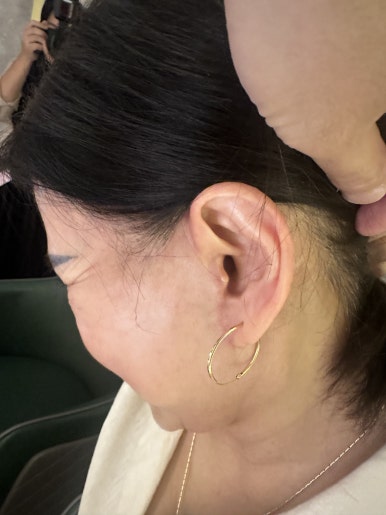 Revision Facelift 3 Months Later, Including Removal of the Existing Scar image 15