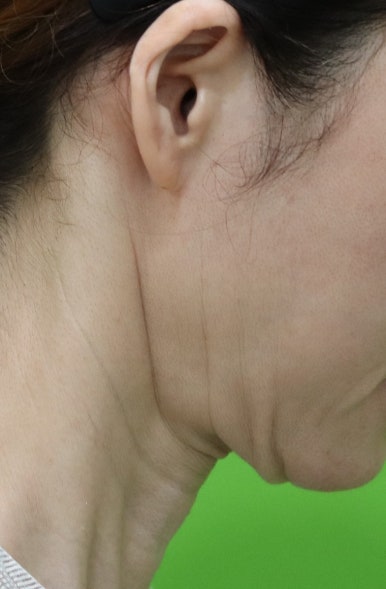 Facelift Scars, the Reason They Look Seamless After 6 Months image 6